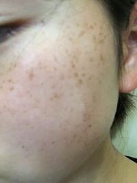 ソバカスについて 中学2年生の女です 小4くらいから目立ち始めたそば Yahoo 知恵袋