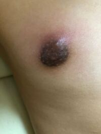 5日前に友達に乳首をつねられて乳首の右上にしこりのようなものが Yahoo 知恵袋