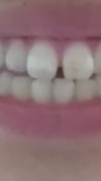 すきっ歯なので直したいですなので市販のマウスピースをしようと思 Yahoo 知恵袋