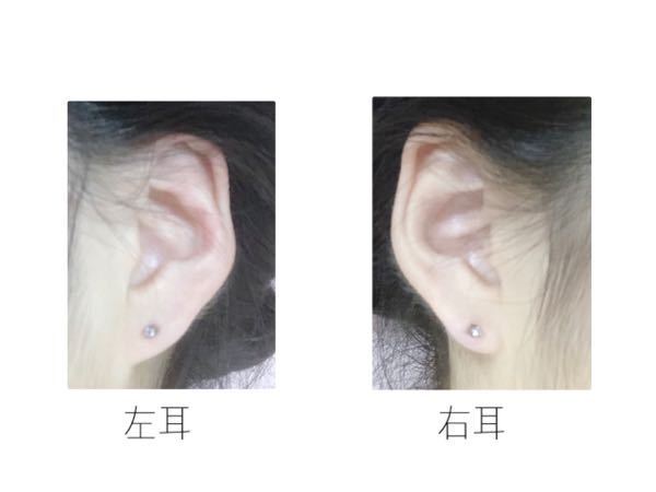 初めてピアスを開けたのですが 左右で耳の形が違うため 位置が非対称に Yahoo 知恵袋