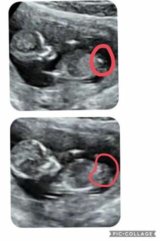 妊娠13週の妊婦です 写真は12週6日のエコーなのですが Yahoo 知恵袋