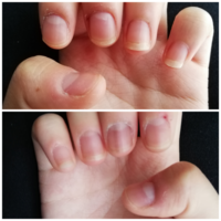 画像汚くて申し訳ありません 私は元々爪を噛む癖があったのですが 大学生に Yahoo 知恵袋