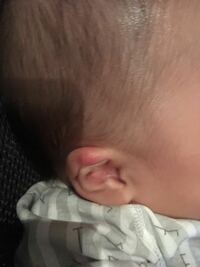 生後一ヶ月の赤ちゃんの耳の付け根に写真のようなブツブツがあります 写真に Yahoo 知恵袋