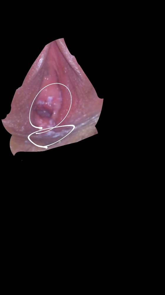 観覧注意 見苦しい写真すみません 膣口に白いできもの があってその下は Yahoo 知恵袋