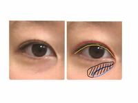[目の写真有り] 目のくま、蒙古ひだについてです。

中2ですが、目のくまが取れず悩んでいます。
目頭の蒙古ひだ？に沿ってくまができており、
疲れていて老けている様に見えてしまいます…

画像右の色で表すと
赤→二重の線(蒙古ひだというのでしょうか)
黄→目のふち
青→特に濃いくま(青っぽいです)
黒→上をむくと薄くなる

くま部分は皮膚がへこんでいる、薄いです。
何くまなのかはっきりは分か...