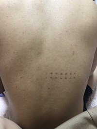 背中にたまにこのような斑点ができます 別に何かの跡がついたもか Yahoo 知恵袋