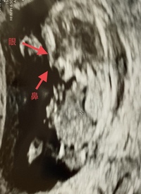 エコー写真の目が真っ黒 妊娠12週 超音波で見た赤ちゃんの横顔なんですが Yahoo 知恵袋