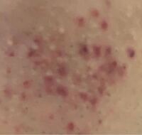 閲覧注意です ニキビのことでお聞きしたいです これは何ニキビですか Yahoo 知恵袋