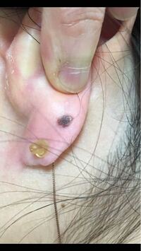 ピアスを通している時にたまたま耳の裏側を見たのですが ホクロの大きくなっ Yahoo 知恵袋