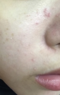 コメド大量発生について私は普段からそこまで肌荒れするタイプでも Yahoo 知恵袋