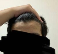 明らかにハゲてきてます 高校生です 親 祖父母ともにハゲ Yahoo 知恵袋