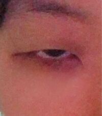 これ 眼瞼下垂ですか まぶた重いし眠いです 21おんすっ Yahoo 知恵袋