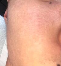 高校生男子ですが 写真の通り肌がきたないです 朝と夜2回洗顔をし Yahoo 知恵袋