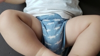 生後2ヶ月の赤ちゃんの足首のしわが左右非対称なのですがこれは脱臼でしょう Yahoo 知恵袋