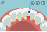 至急 歯の裏の根元部分に赤く書いたように血の塊みたいなのがあるんですが Yahoo 知恵袋
