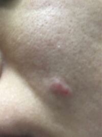 数日前から頬の辺りにこのような出来物ができました 触ると固 Yahoo 知恵袋