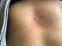 胸の真ん中の左へんに 硬いけど 骨よりは硬くないしこりのような感触 Yahoo 知恵袋