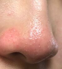 鼻の横がチーズというか う この匂いがします 毎日洗顔をして Yahoo 知恵袋