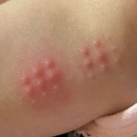 gワクチンについて gワクチン接種2日目なのですが こちらは Yahoo 知恵袋