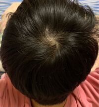 つむじハゲかもしれません ネットで調べたら頭皮の色が赤っぽいと Yahoo 知恵袋