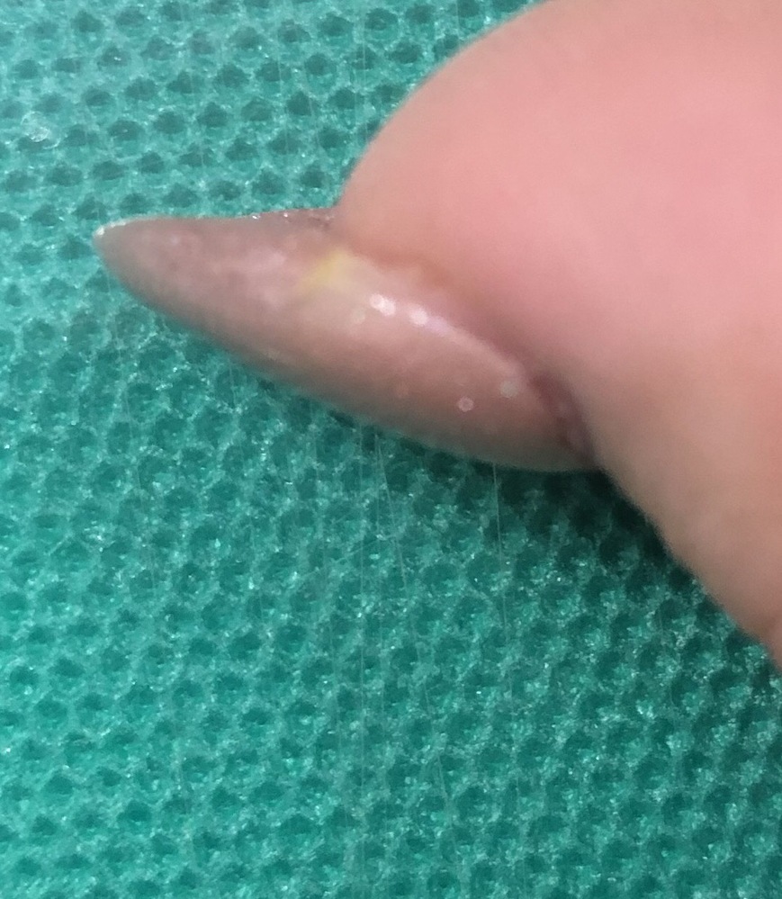 これはグリーンネイルになりかけてますか そのようにも見え Yahoo 知恵袋