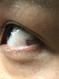 目の白目の部分に紫色のものができました 気付いてから10日たちますが 大 Yahoo 知恵袋