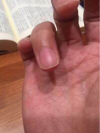 汚い指でごめんなさい なんか指先が痛いなぁと思い ふと見てみたら爪 Yahoo 知恵袋