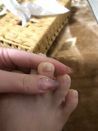 足の親指の爪の上半分が爪甲剥離症なんですが 爪は取らない方がい Yahoo 知恵袋