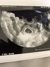 胎嚢が 8mm 胎芽が 3 1mmなのですが 妊娠周期はどのく Yahoo 知恵袋