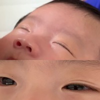 生後3ヶ月の子供です 眠い時に画像のようになります 起きると完全な一重で Yahoo 知恵袋