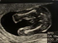 17週のエコーです 下からのアングルなのですが 男の子でしょう Yahoo 知恵袋