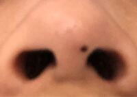 鼻の穴と穴の間にホクロがあります なんか前より黒々しくな Yahoo 知恵袋