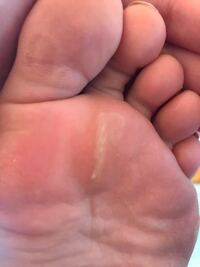 足の裏に厚い皮がありヒールやブーツを履くと違和感があり歩きづら Yahoo 知恵袋