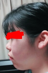 横顔の頬肉の落とし方を知りたいです 輪郭三点の整形手術をすれば Yahoo 知恵袋