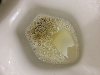 排尿後 約1分経過した後の尿写真です この尿の泡立ち具合 色から糖尿病そ Yahoo 知恵袋