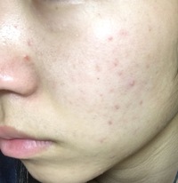 閲覧注意 陰部が痒いし痛い 数日前まで生理でナプキン蒸れ Yahoo 知恵袋