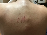 彼氏の背中の引っ掻き傷 彼氏の背中の右側に多数の引っ掻き傷があり Yahoo 知恵袋
