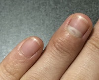 ぶつけた指 爪の白さについて1ヶ月ほど前に 薬指の爪の付け根部分を扉にぶ Yahoo 知恵袋