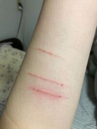 ボディステッチって痛くないの 中学生でやってる人いる ボディステ Yahoo 知恵袋