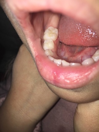 子どもの虫歯 子どもの奥歯が画像のように黒い点のようなものがあるのですが Yahoo 知恵袋