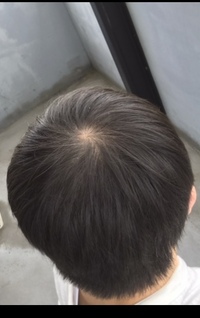 若はげについて現在高校生2年です この歳で薄毛に悩んでいます 静岡でおす Yahoo 知恵袋