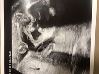 24週のエコー写真なのですが こちら口唇口蓋裂ではないかと不安 Yahoo 知恵袋