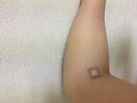 高濃度ビタミンc点滴をしたのですが 点滴漏れがあり 腕が肘の方までパンパ Yahoo 知恵袋