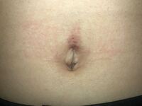 病院でへそピをあけたのですが これってどうですか 曲が Yahoo 知恵袋