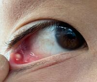 これはものもらいですか 一昨日くらいから目の下が痛く見て Yahoo 知恵袋