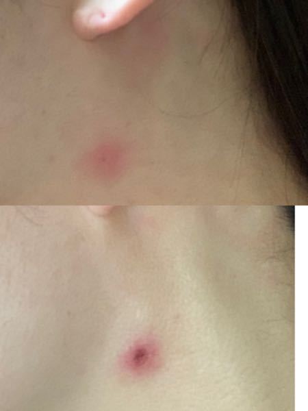 これはムカデに刺されたのでしょうか 上の画像は刺されたと Yahoo 知恵袋