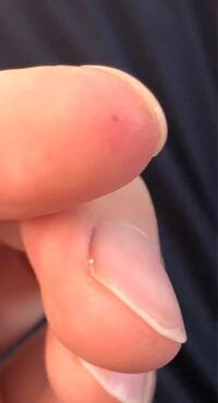 園芸中にチクッとした痛みがあり 人差し指を見てみたところ 黒い線状のもの Yahoo 知恵袋