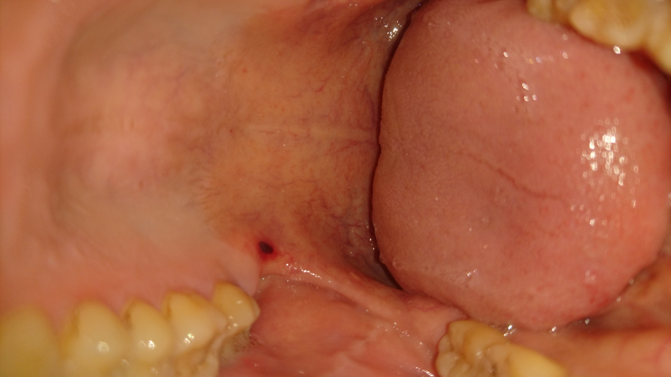 口の中に黒いできものができていました 食事をした後に上顎 Yahoo 知恵袋