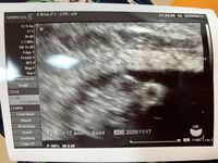 ラムジーメソッドわかる方いますか 8週２日のエコーです 毎回左の方 Yahoo 知恵袋