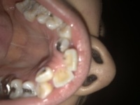 １５歳女子です 虫歯がひどいです これは抜歯になってしまうでし Yahoo 知恵袋